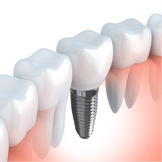 IMPLANT インプラント