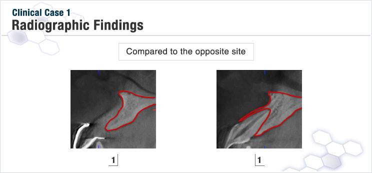 図2 抜歯後の歯槽骨の状態 （左：抜歯後）（右：反対側同名歯の健康な状態）