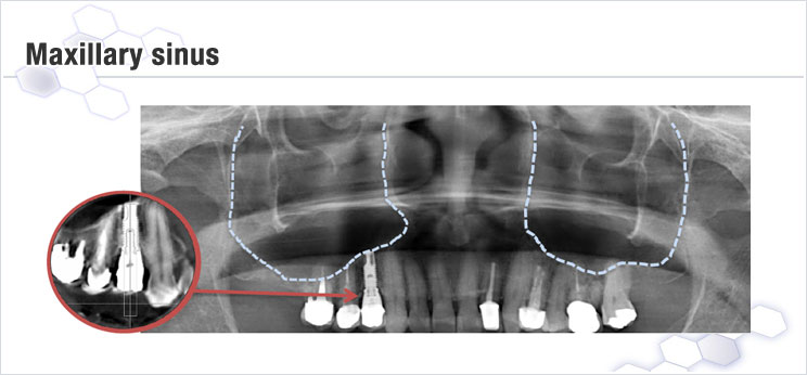 上顎洞の位置とインプラント（X線撮影像）