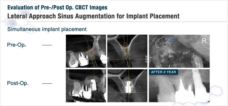 図7 サイナスリフトとインプラント同時埋入手術