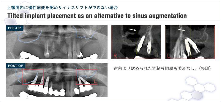 図9 インプラント傾斜埋入による症例