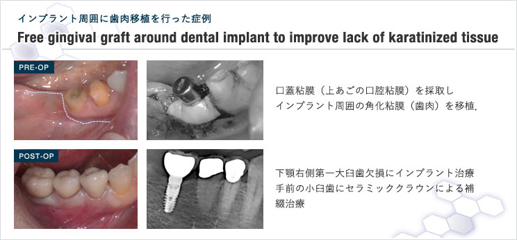 図12 インプラント周囲に角化粘膜を増やしたケース