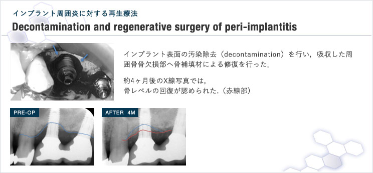 図11 インプラント周囲疾患(Peri-implant disease)