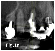 Coronal aspect