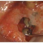 歯根根尖部の明示根穿孔が開大し、汚染が確認できる