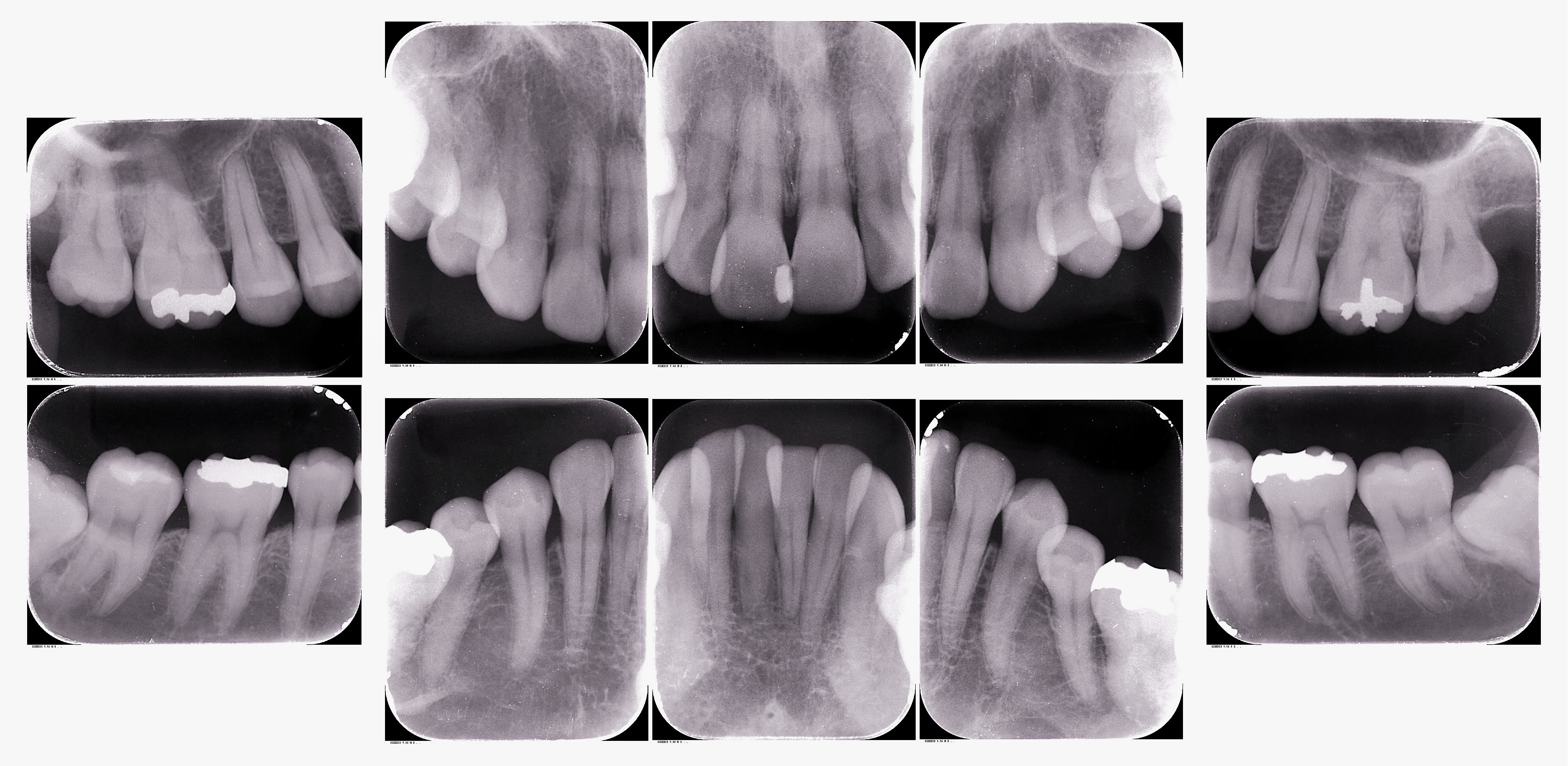 デンタルＸ線10枚法