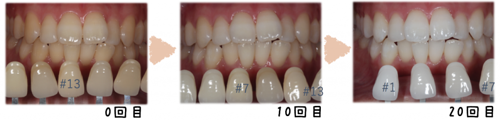 ホワイトニング症例写真