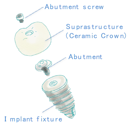 スクリュー固定式のインプラントの構造