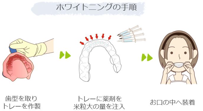 ホームホワイトニングの手順